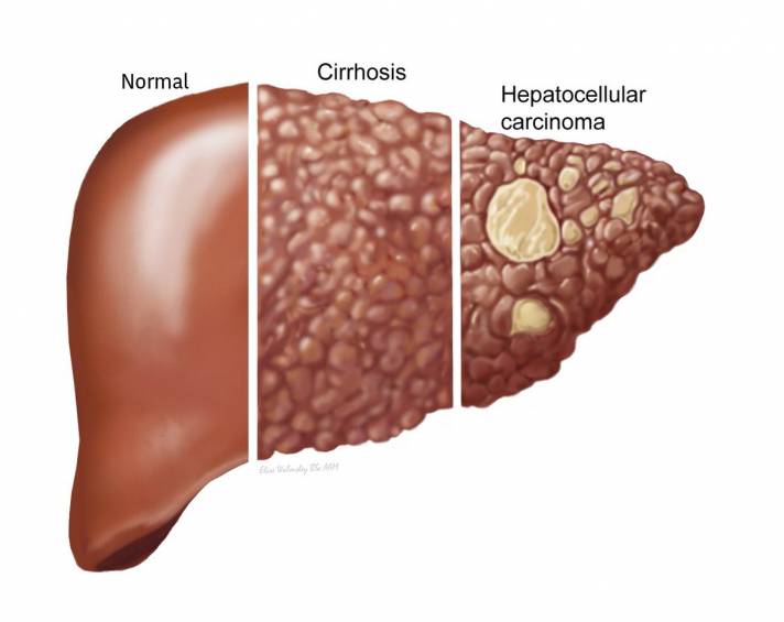 ما هي أعراض تليف الكبد