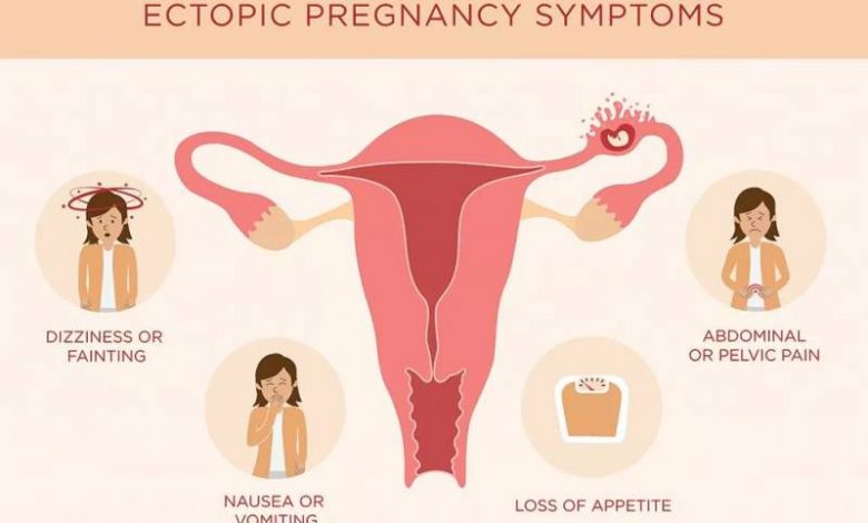 Ectopic Pregnancy 1