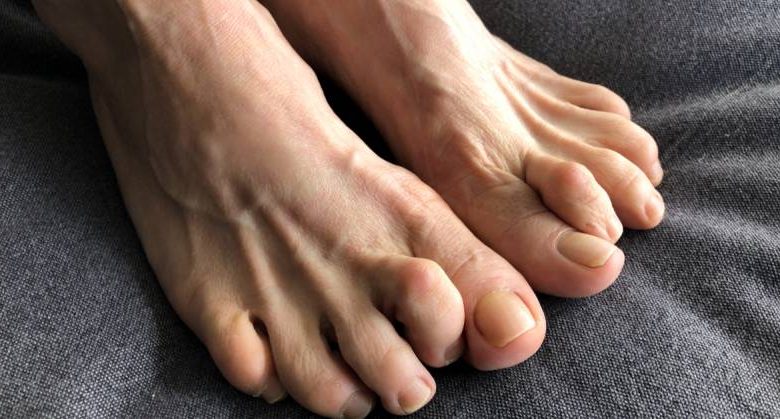 أسباب إصبع القدم المطرقية