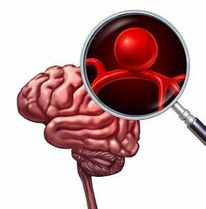 معلومات حول تمدد الأوعية الدموية في الدماغ