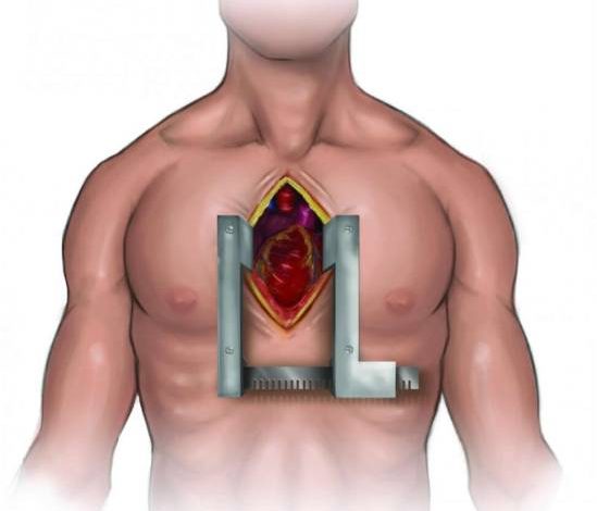 فترة-التئام-العظام-بعد-عملية-القلب