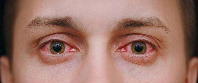 علاج-احمرار-العين