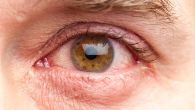 الذي يسبب عوامات العين؟