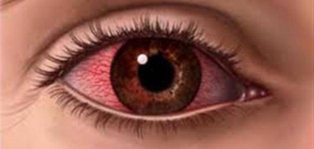 علاج-حساسية-العين-واحمرارها-في-المنزل