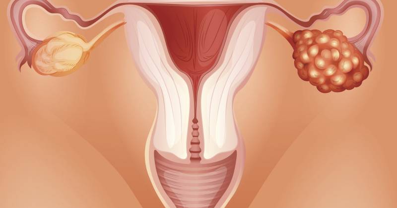 علاج مرض أكياس الشوكولاتة