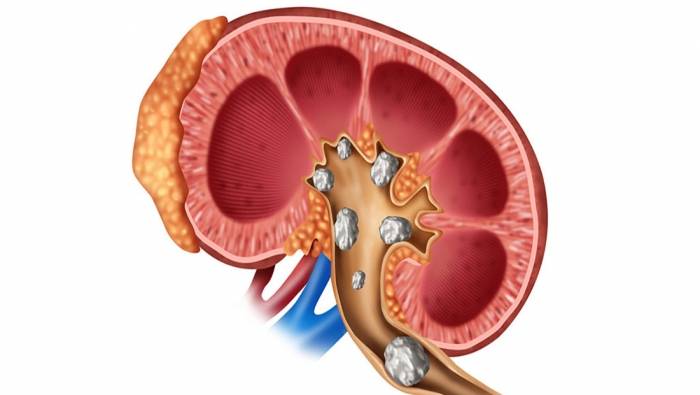 حصى الكلى أعراضها وطرق علاجها